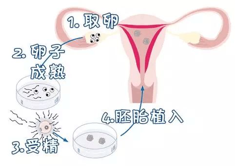丹东试管婴儿助孕