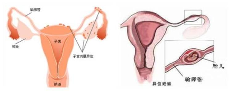 云南试管助孕费用
