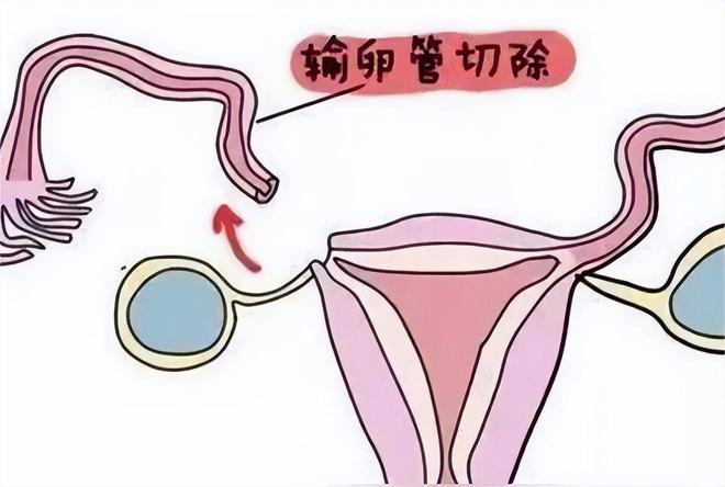 乌克兰试管婴儿