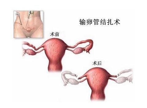 试管婴儿