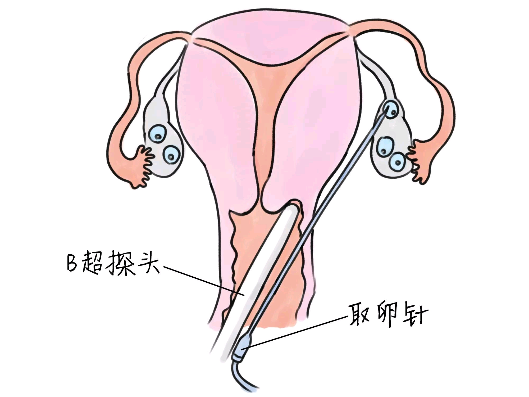 上海捐卵代怀生子